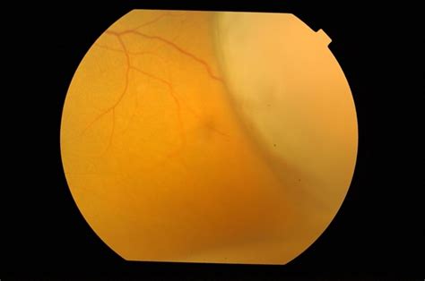 Uveitis With Exudative Retinal Detachment Retina Image Bank