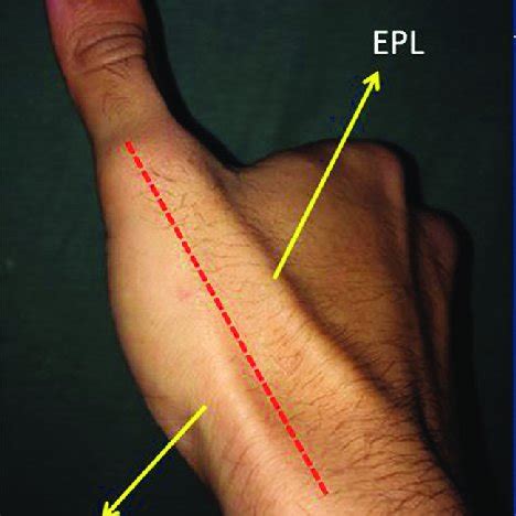 A Clinical Picture Showing The Surface Marking Of The Extensor Pollicis Download Scientific