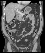 Mirizzi Syndrome Radiology Reference Article Radiopaedia Org