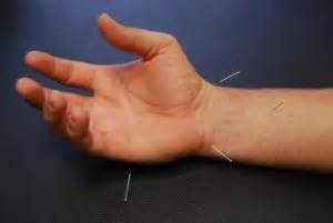 Dry Needling Acupuncture Pain Relief Synergy Chiropractic Of Houston