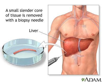 Liver Biopsy MedlinePlus Medical Encyclopedia Image