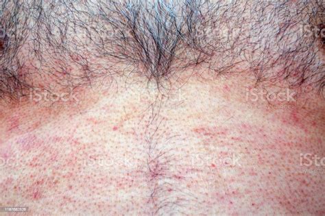 Extreme Closeup Photography Of The Atocpic Dermatitis Symptoms Stock