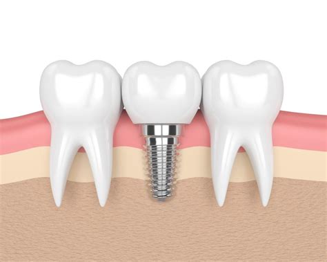 Dental Implants All You Need To Know