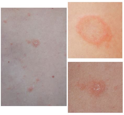 Pityriasis Pityriasis Rosea Wikipedia The Exact Cause Is Unknown