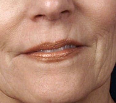 What is the difference between the sizes and how do each benefit the skin? Microneedling Treatment - Dermatology Pittsburgh