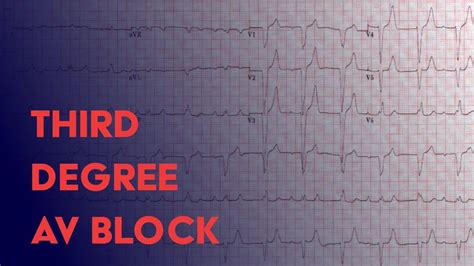 Third Degree Complete Heart Block Ekg Ecg Interpretation Youtube