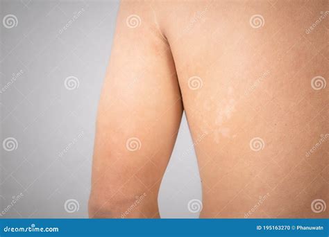 Tinea Versicolor Pityriasis Versicolor Skin Infection On The Back Is A Type Of Fungal Disease