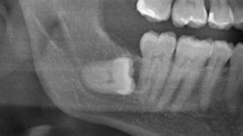 Odontogenic Dentigerous Tooth Cyst Impacted Wisdom Tooth Coronectomy