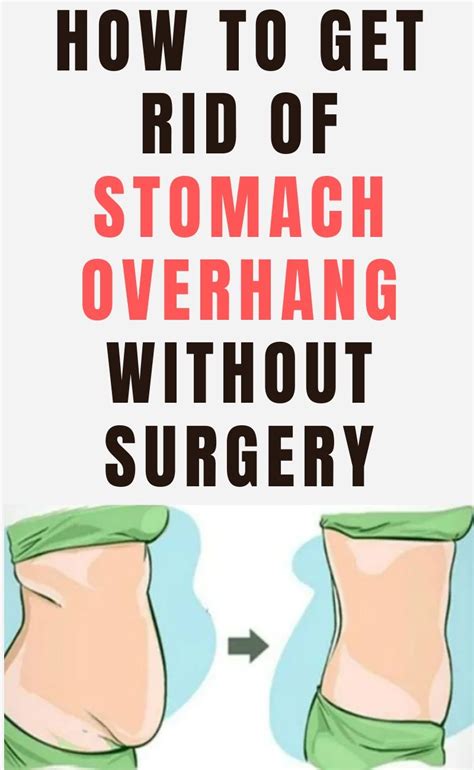 10 Tips On How To Get Rid Of Stomach Overhang Without Surgery