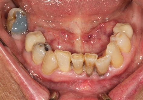 Management Of Mandibular Anterior Teeth With Gingival Recession 182