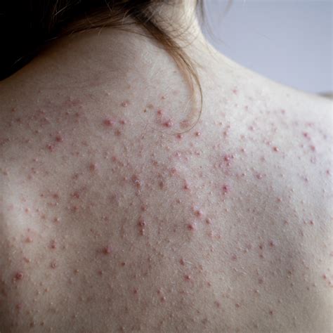 Acne On Back Causes