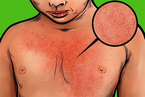 How To Identify Common Childhood Rashes The New York Times