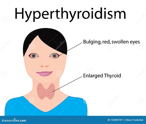 Hyperthyroidism Enlarged Thyroid Endocrine Disfunction Vector Stock