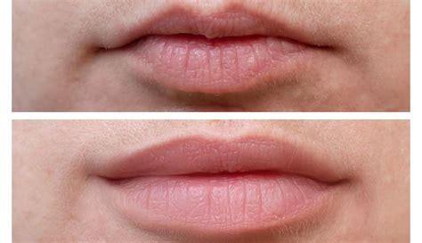Everything About Lip Flip With Botox North York Cosmetic Clinic