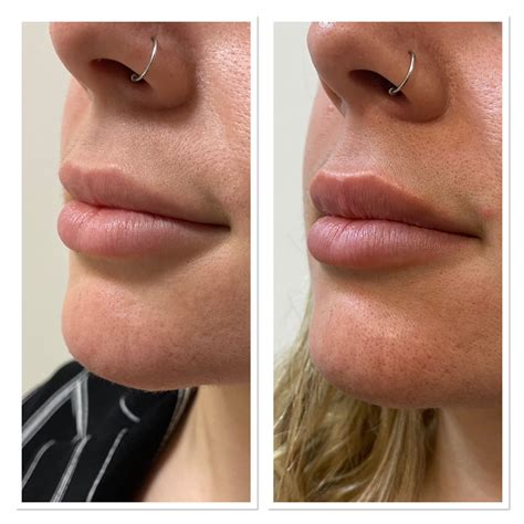 Lip Flip Botox Before And After Photos Infoupdate Wallpaper Images