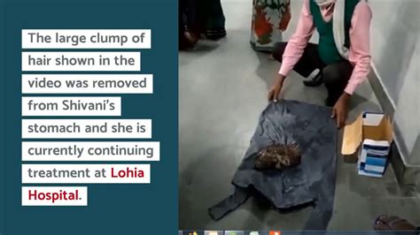 doctors remove 3 kg hairball from stomach of 15 year old girl in northern india youtube