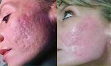 What''s The Best Acne Treatment Pictures
