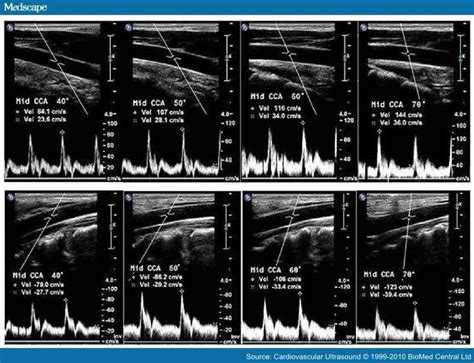 Standardized Ultrasound Evaluation Of Carotid Stenosis For Clinical