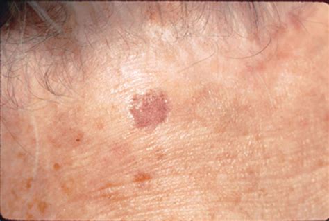 Signs Of Skin Cancer This Skin Check Can Save Your Life Glamour