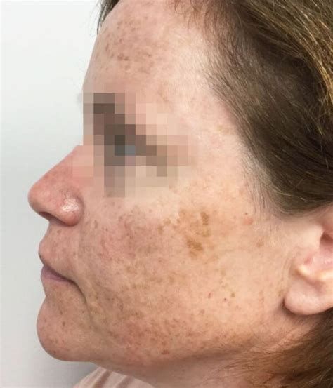 Ipl Photofacial Before And After Academic Alliance In Dermatology