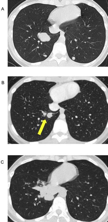 Spontaneous Regression Of Metastatic Extraskeletal Myxoid