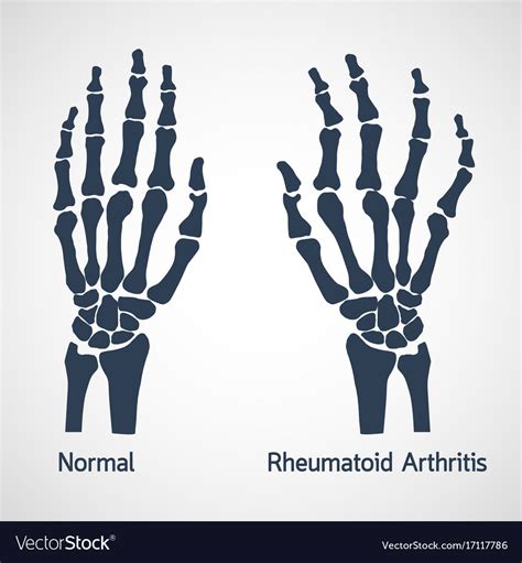Rheumatoid Arthritis Icon Royalty Free Vector Image