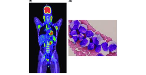 A 18 F Fdg Petct Shows Hypermetabolic Lesions In Multiple Lymphoid
