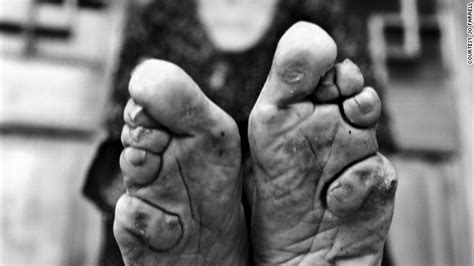 Last Living Women With Bound Feet
