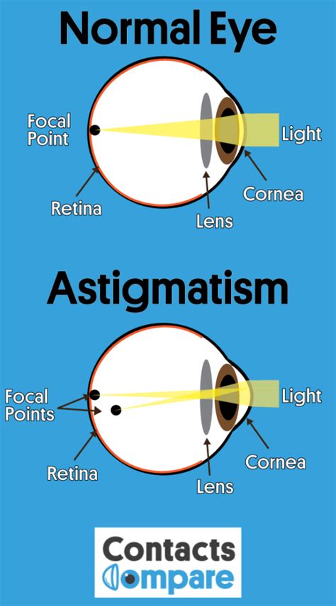 Astigmatism Causes Symptoms Treatments Contacts Compare