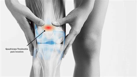Quadriceps Tendinopathy Symptoms Causes And Treatment The Best Porn Website