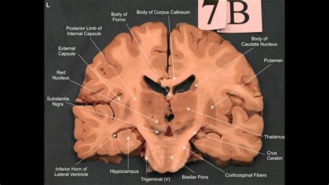 Coronal Slice Of Brain Diagram Quizlet