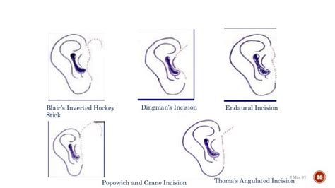 Surgical Approaches To Tmj