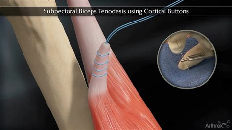 Arthrex Subpectoral Biceps Tenodesis Using Cortical Buttons