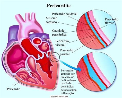 May 30, 2018 · péricardite. Pericardite aguda ou crônica e constritiva, sintomas e causas
