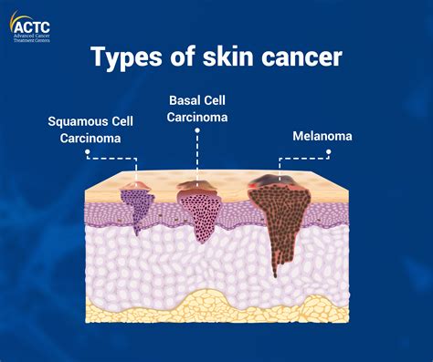 Types Of Skin Cancer Cells