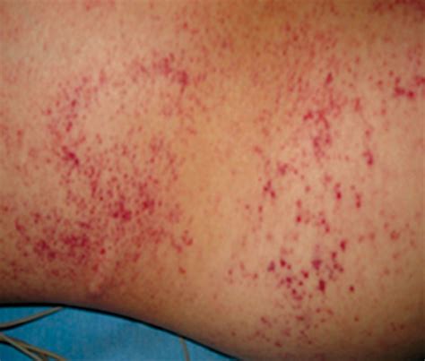 Petechiae Rash On Legs Causes