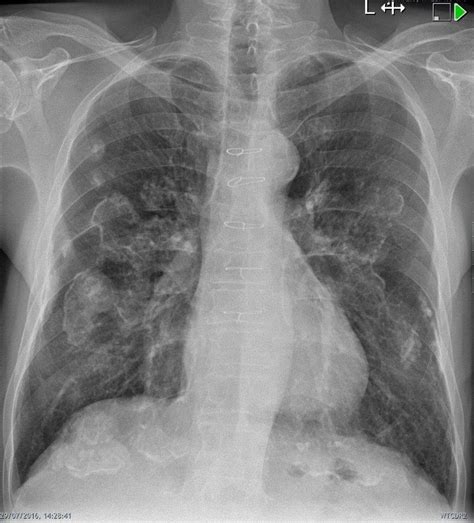 Sizes range from smallest (1.3cm x 2cm) to largest (1.7cm x 3.5cm) initials/numbers. The holly leaf sign refers to the appearance of pleural ...