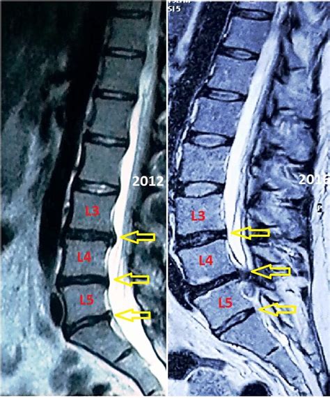Sequestered Herniation Of The Spinal Disc L L L S Symptoms