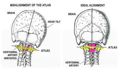 Atlas Orthogonal Chiropractic Technique Is It Right For You