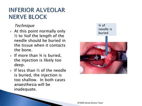 Inferior Alveolar Nerve Block In Children