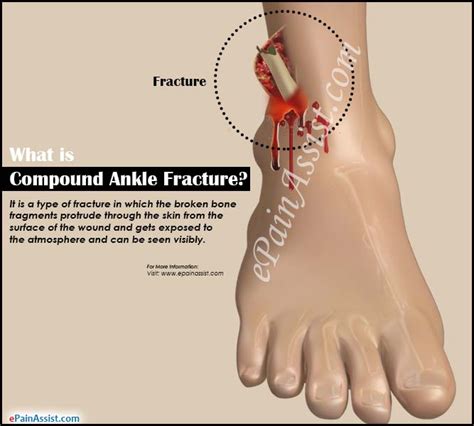 Compound Ankle Fracturecausessymptomstreatmentrecovery