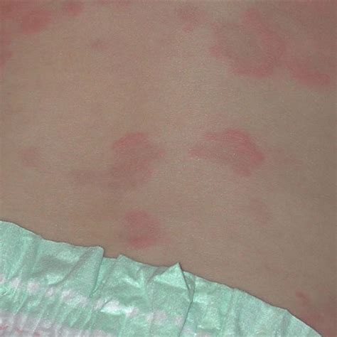 Hives Urticaria In Children