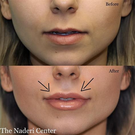 Non Surgical Lip Augmentation Of Thin Lips With 1 Cc Of Juvederm Ultra