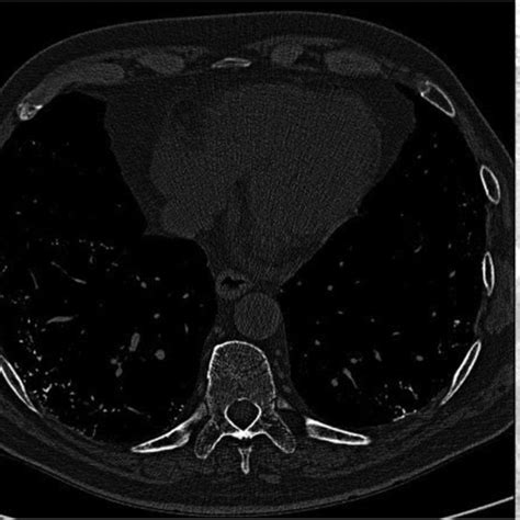 A B C High Resolution Computed Tomography Hrct Scan Lung A And
