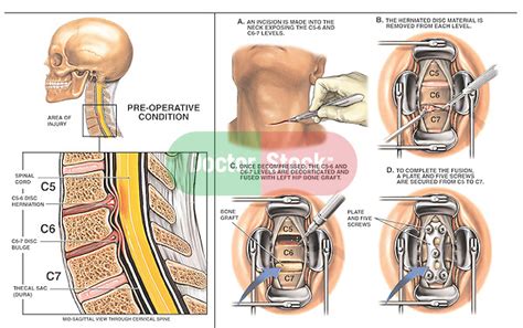 C5 6 And C6 7 Disc Herniations With Two Level Anterior Discectomy And