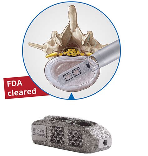 Endolif Spinal Implants Endoscopic Spinal Stabilization Fusion