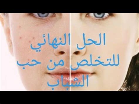 مِن التعليم إلى سوق العمل. ‫الحل النهائي للتخلص من حب الشباب.‬‎ - YouTube