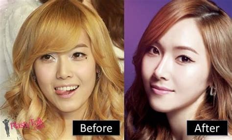 Jessi Kpop Plastic Surgery Before And After