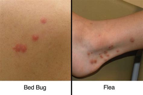 Dust Mites Bites Vs Bed Bugs Bites