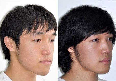 Case 20 Lower Jaw Surgery And Genioplasty Sydney Oral And Facial Surgery